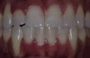After Image: Invisalign