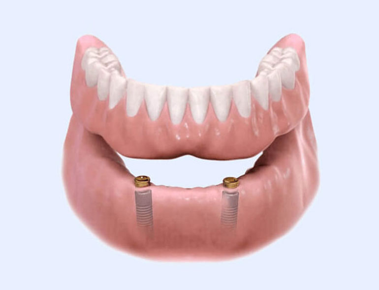 Choosing Between Fixed and Removable